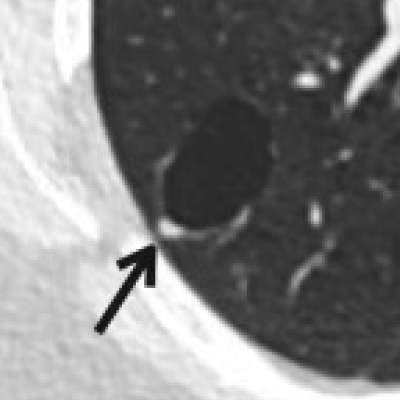Focal Thickness